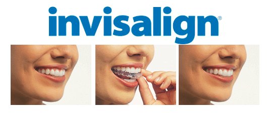How Much Does it Cost to Get Invisalign in Austin, TX?