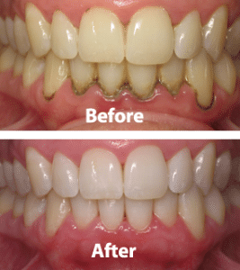 Periodontal-before-after-01