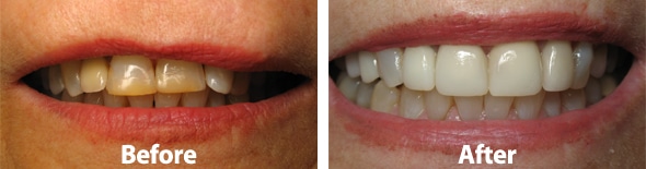 Composite Bonding: 5 Things it Can Do for Your Smile - Austin Laser Dentist  - Helen Ragsdale DDS - Austin Dentist