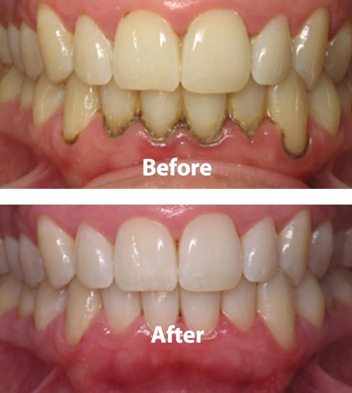 Periodontal-before-after-02-large