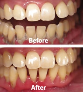periodontal-before-after-001