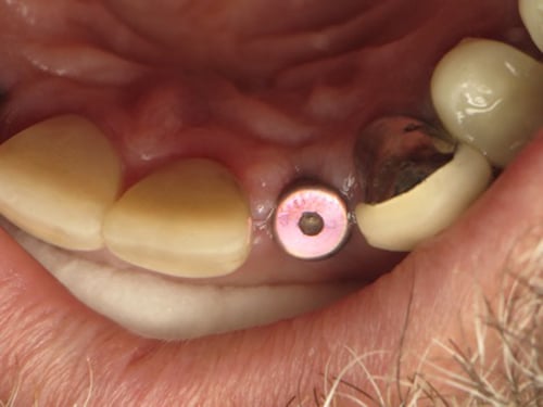 Austin Dental Implant Healing Cap