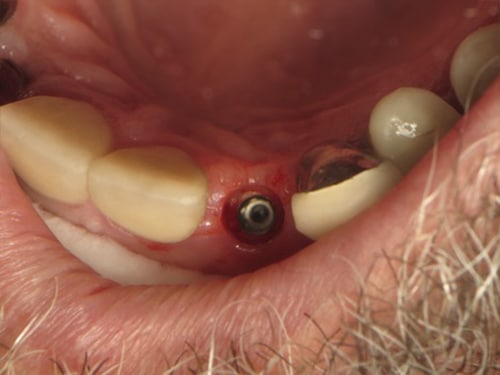 Dental Implant 