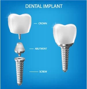 Cost of Dental Implant [Converted]