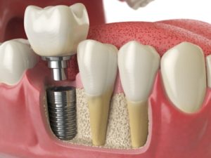 What are dental Implants Austin