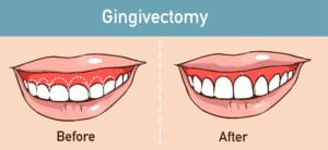 aesthetic dentistry laser gum lift surgery to correct a gummy smile