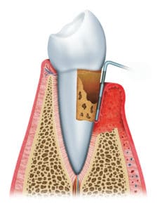 gum disease