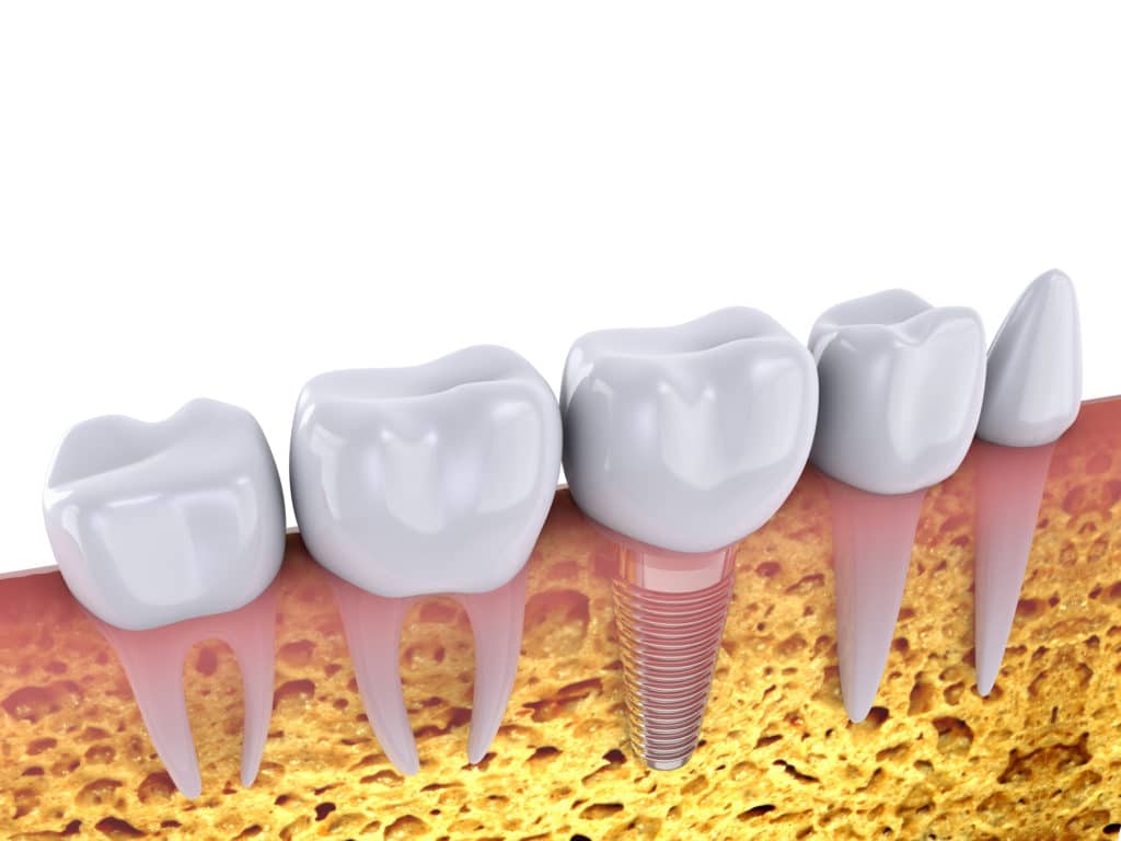 a dental implant works like a real tooth