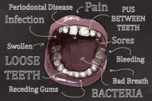 symptoms of periodontal disease