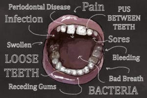 periodontal disease