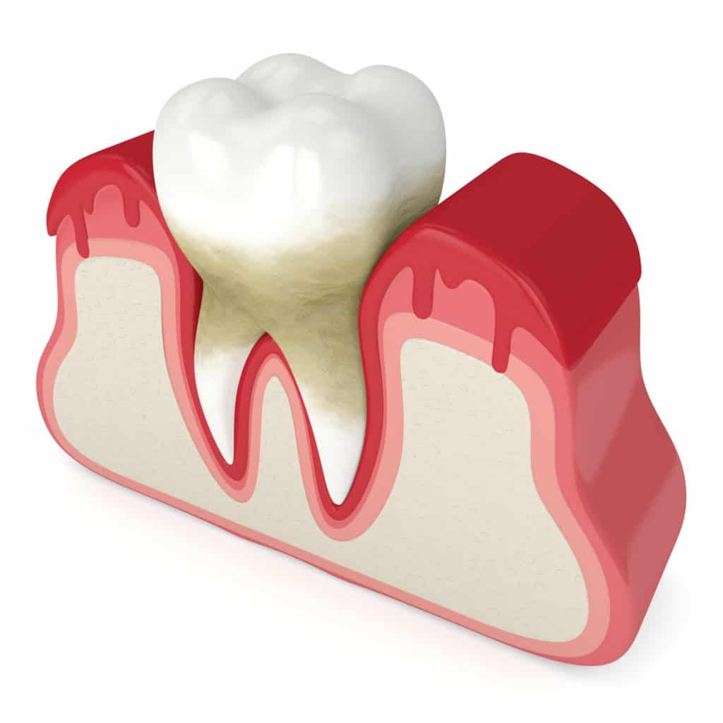 3d render of tooth with periodontal disease