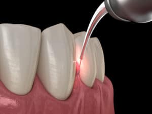 laser gum treatment