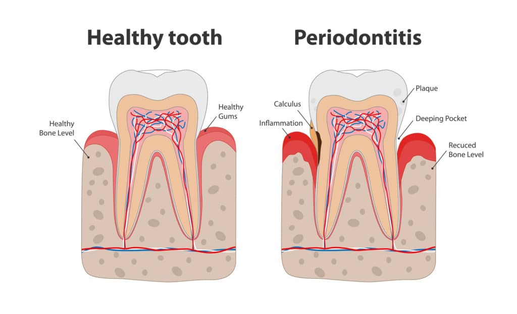 chart showing healthy tooth vs periodontal disease