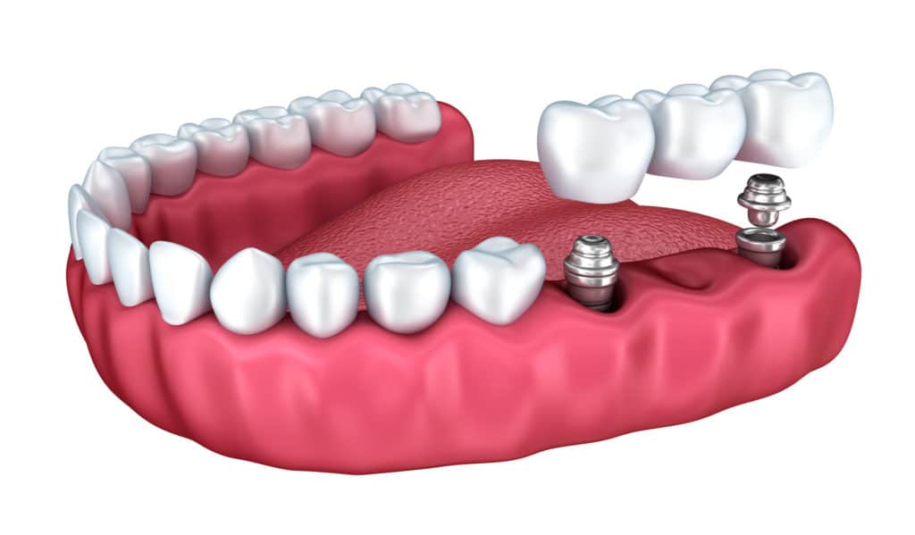 dental bridge being attached to dental implants