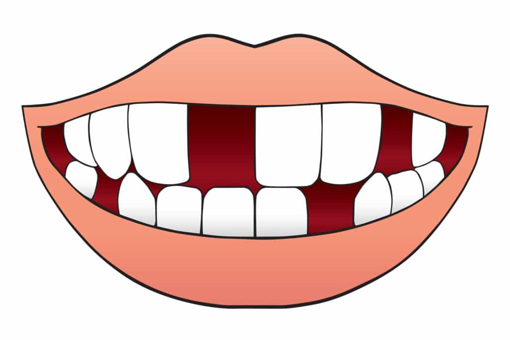 illustration of missing teeth