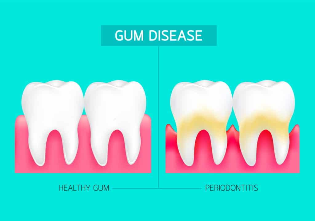 Austin Laser Gum Disease Therapy
