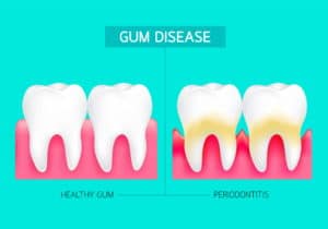 Austin Laser Gum Disease Therapy