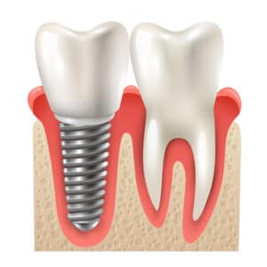 Illustration showing how dental implants sit in the jawbone