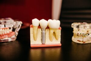 A cross-sectional model displaying how dental implants are inserted into the jaw bone to replace missing teeth.