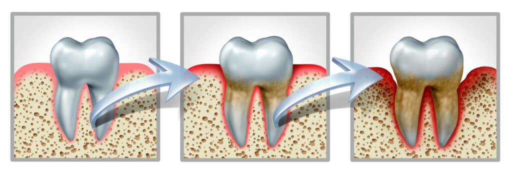 An illustration of the progression of gum disease necessitating periodontal disease treatments in Austin, TX