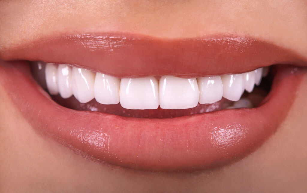 woman smiling with tooth veneer (dental veneers)
