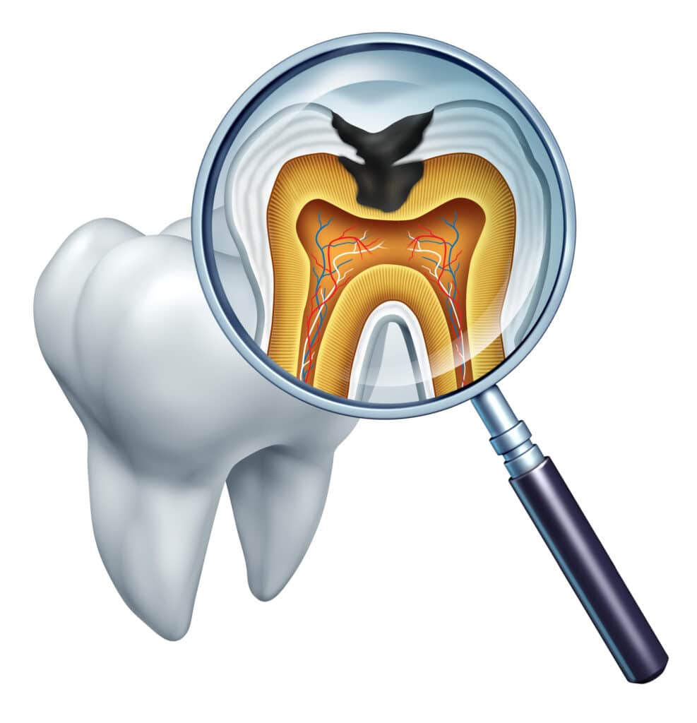 An illustration of a tooth and magnifying glass depicting a cross-sectional image of a tooth with cavities