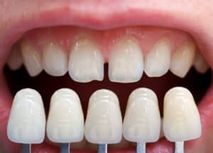 A shade guide for dental veneers in Austin, TX