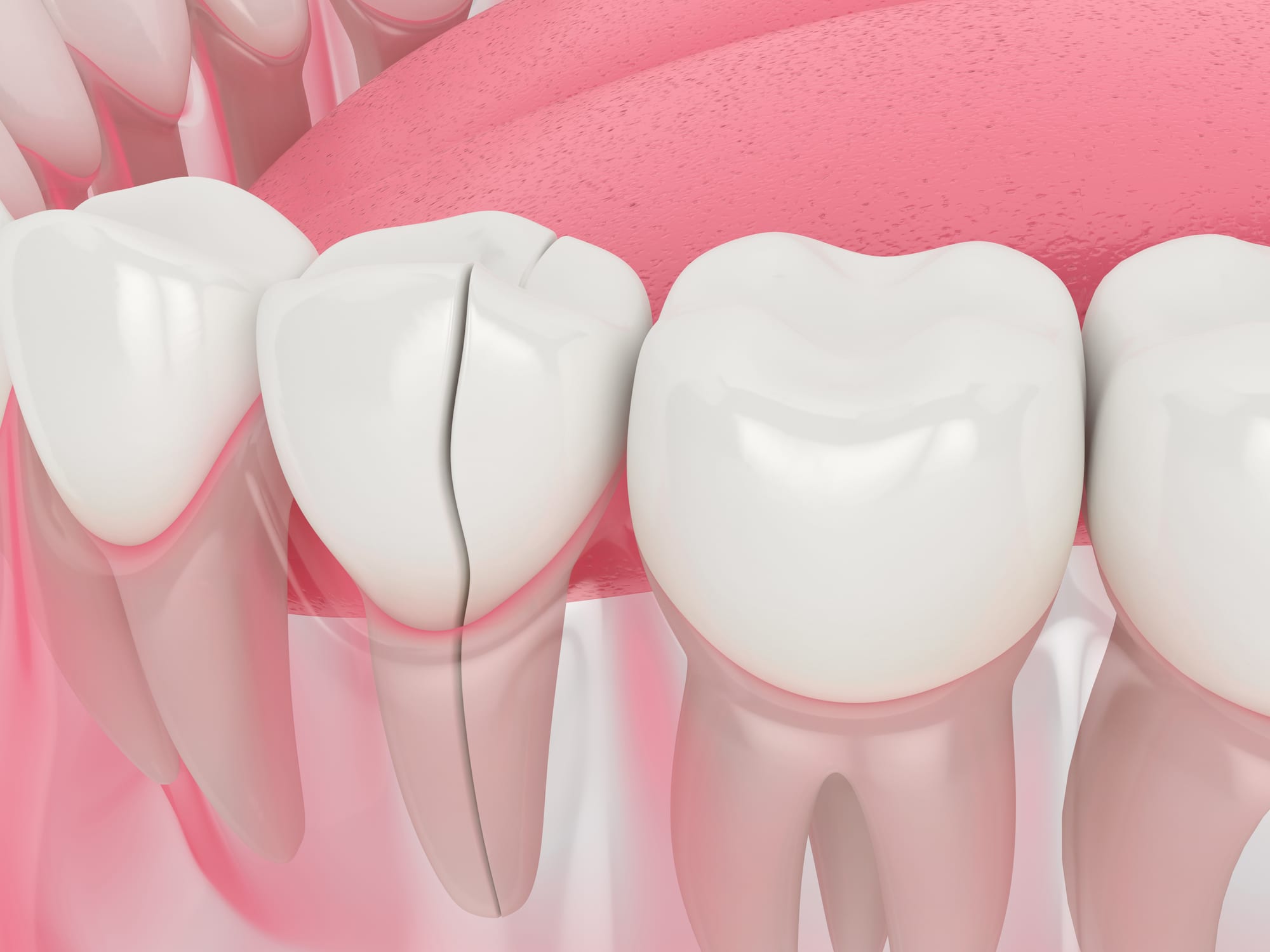 4 Ways To Fix A Cracked Tooth Austin Laser Dentist Helen Ragsdale 