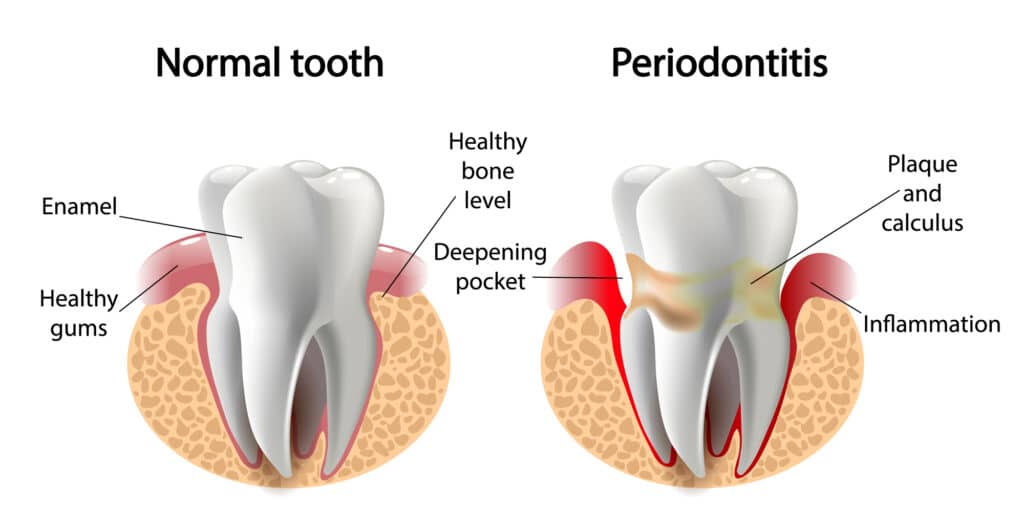 Illustrative figure demonstrating the differences in a tooth with and without gum disease