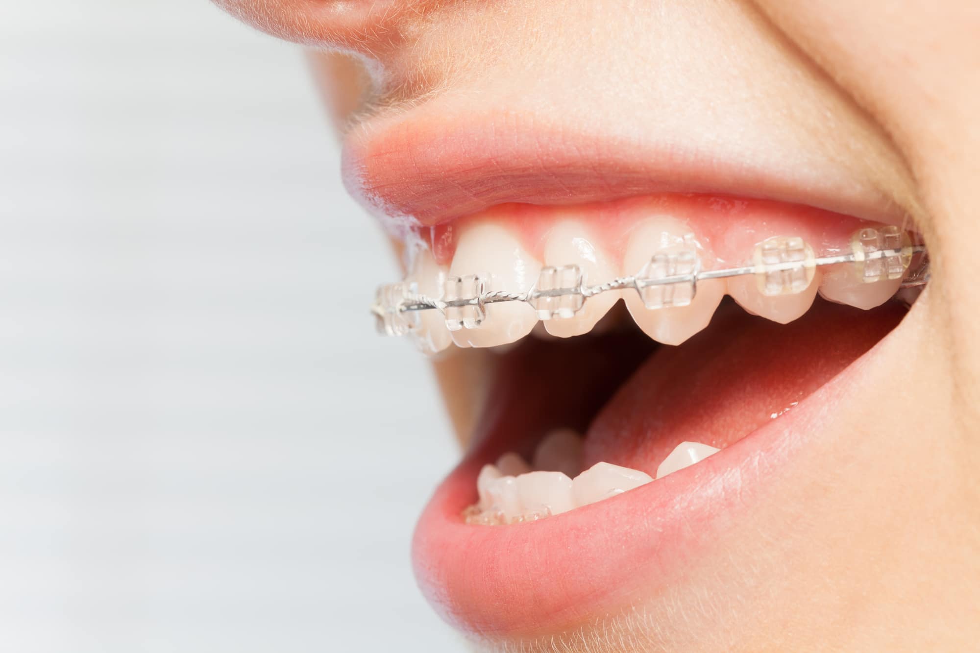 Clear Braces vs. Invisalign - Austin Laser Dentist - Helen