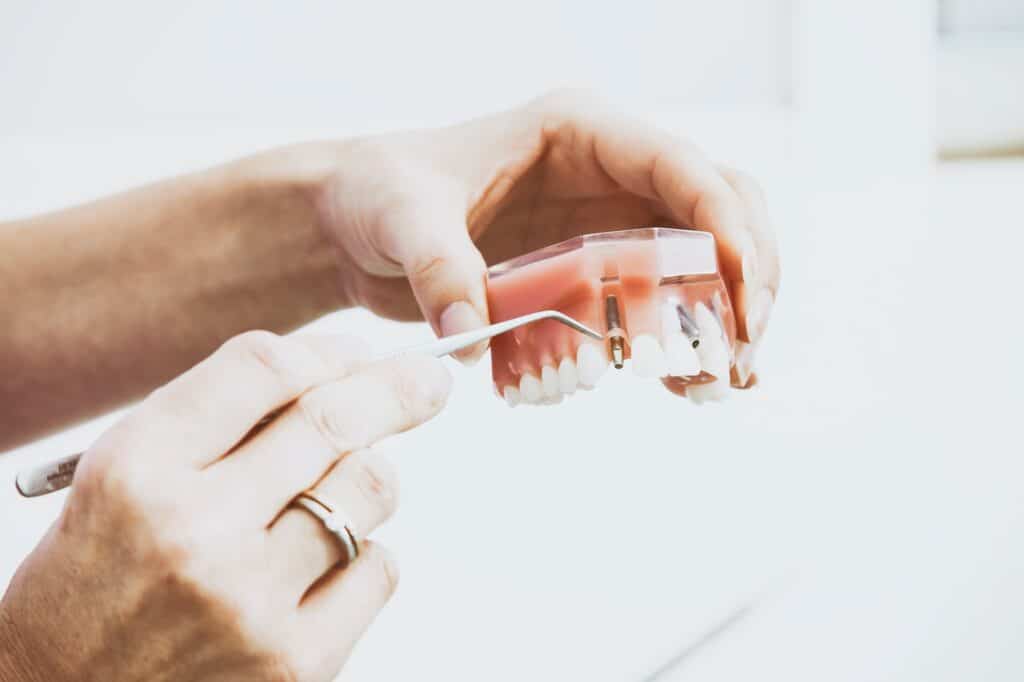 dentist holding prosthetic mold of teeth showing dental implant