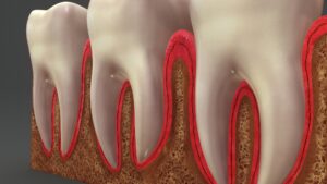 graphic of teeth with gum disease