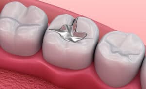 silver dental fillings