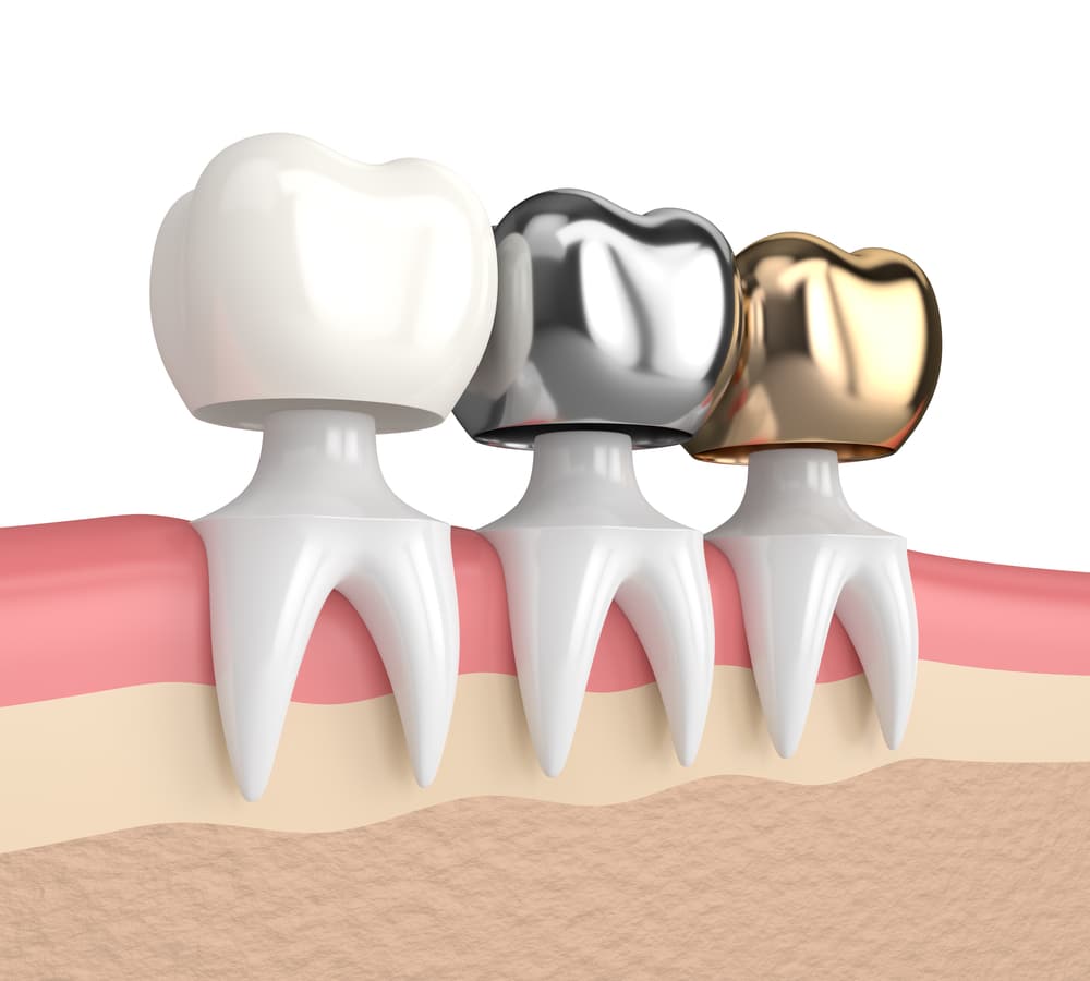 3d Render Of Teeth With Different Types Of Dental Crown - Austin Laser ...