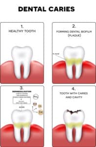 diagram how cavities form in 4 images