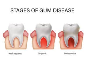 Collage with illustrations of healthy tooth with gum and infected ones showing stages of disease. Gingivitis and periodontitis