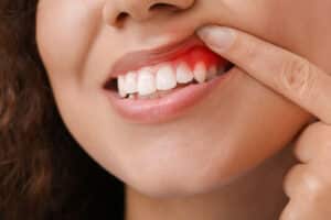 close up of woman with perio disease showing her gums