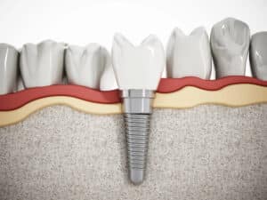 dental implant place in lower jaw