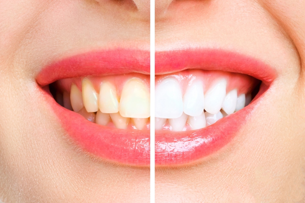 teeth whitening before and after