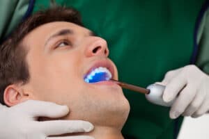 dentist using UV light for tooth bonding on male patient