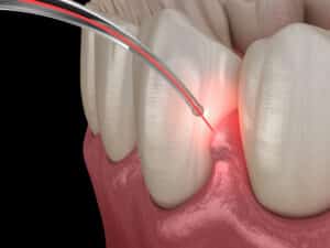 gum correction surgery with laser