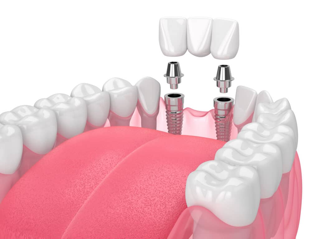 Austin TX dental implant retained bridge