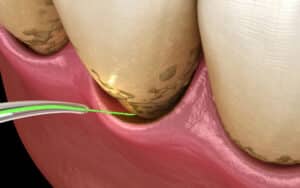 laser dentistry