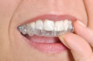 Austin TX Invisalign dentist