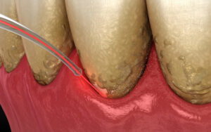 laser periodontal disease treatment