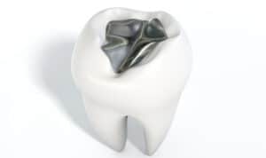 tooth with silver filling