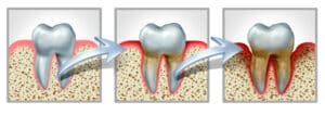 stages of gum illness